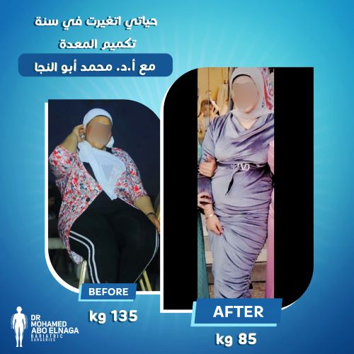 تجاربكم مع تكميم المعدة 1